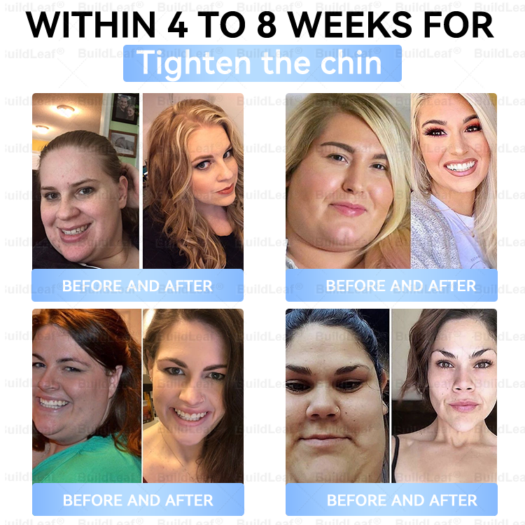 🏥FDA Store |❤️𝐵uil𝗱𝐿ea𝐟® 𝑮𝐋𝑃-1 Slim & Firm 𝑁ano 𝑀icroneedle 𝑃atch with Collagen,Turmeric&Matrixyl 3000 丨Obesity,Cardiovascular Diseas, Diabetes, Sleep Apnea, Joint Problems and More