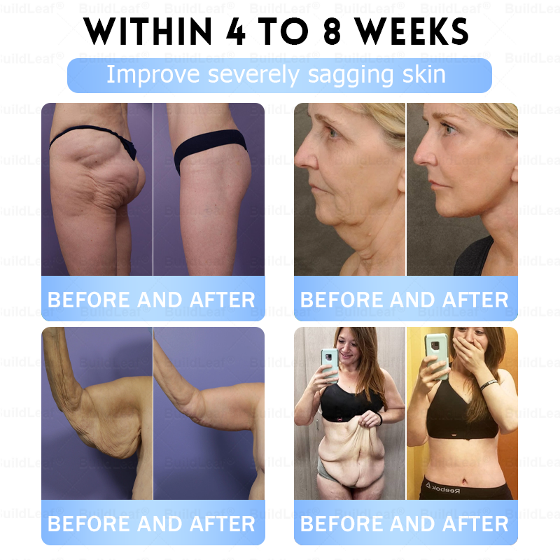 𝐁𝐮𝐢𝐥𝗱𝐋𝐞𝐚𝐟®𝐒𝐥𝐢𝐦 & 𝐅𝐢𝐫𝐦 𝐍𝐚𝐧𝐨 𝐌𝐢𝐜𝐫𝐨𝐧𝐞𝐞𝐝𝐥𝐞 𝐏𝐚𝐭𝐜𝐡 𝐰𝐢𝐭𝐡 𝐌𝐨𝐫𝐢𝐧𝐠𝐚, 𝐎𝐦𝐞𝐠𝐚-𝟑, 𝐂𝐨𝐥𝐥𝐚𝐠𝐞𝐧 𝐏𝐞𝐩𝐭𝐢𝐝𝐞𝐬, 𝐍𝐀𝐃 & 𝐍𝐌𝐍 𝐟𝐨𝐫 𝐎𝐛𝐞𝐬𝐢𝐭𝐲, 𝐂𝐚𝐫𝐝𝐢𝐨𝐯𝐚𝐬𝐜𝐮𝐥𝐚𝐫 𝐃𝐢𝐬𝐞𝐚𝐬𝐞, 𝐃𝐢𝐚𝐛𝐞𝐭𝐞𝐬, 𝐒𝐥𝐞𝐞𝐩 𝐀𝐩𝐧𝐞𝐚, 𝐉𝐨𝐢𝐧𝐭 𝐏𝐫𝐨𝐛𝐥𝐞𝐦𝐬, 𝐒𝐤𝐢𝐧 𝐅𝐢𝐫𝐦𝐢𝐧𝐠, 𝐀𝐧𝐭𝐢-𝐀𝐠𝐢𝐧𝐠, 𝐚𝐧𝐝 𝐌𝐨𝐫𝐞🔥🔥